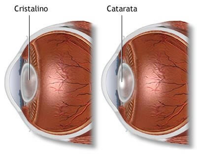 opacificação do cristalino causando catarata