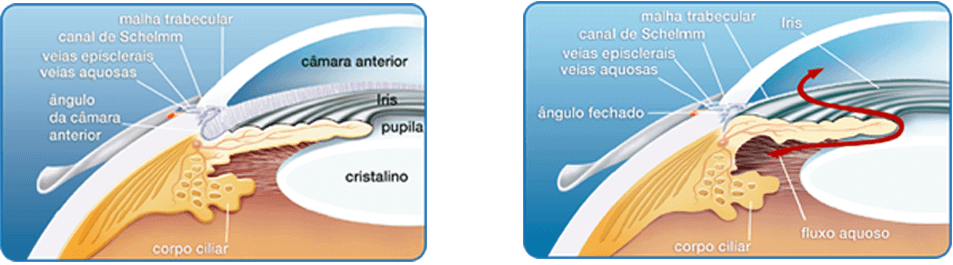 Comparação - Olho com e sem Glaucoma